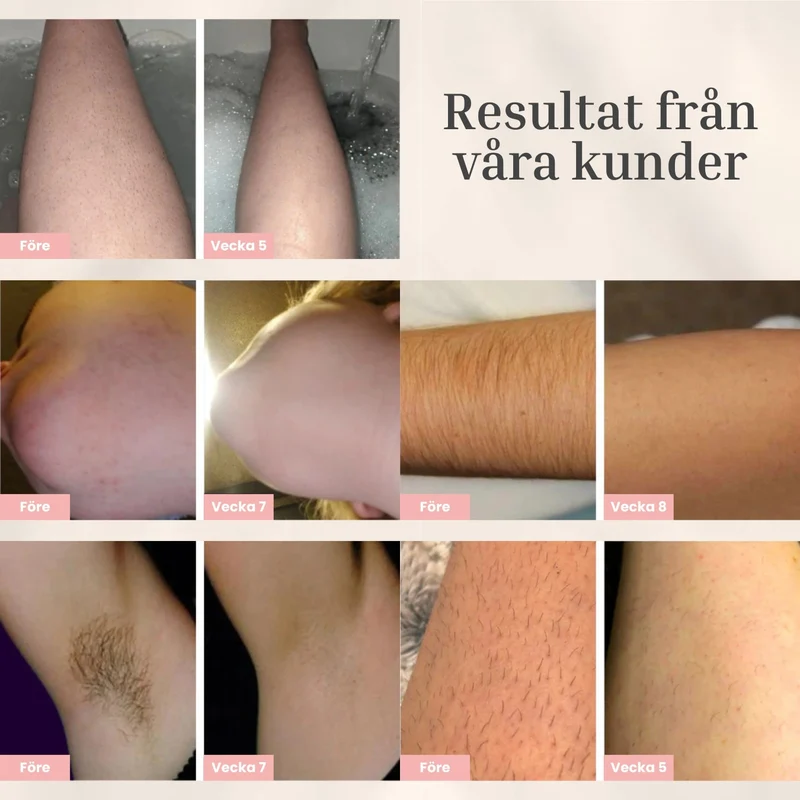 Luvièn IPL Laser - Permanent Laser Hårborttagare
