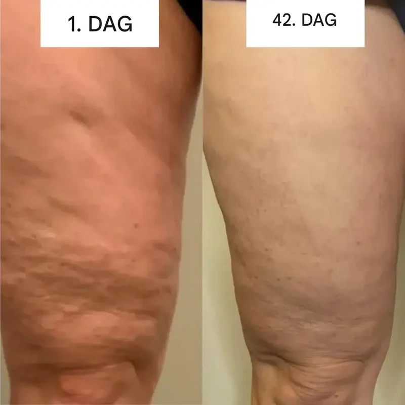GlowCup – Cellulite Remover och Hudåtstramning med Rödljus och Koppningsterapi