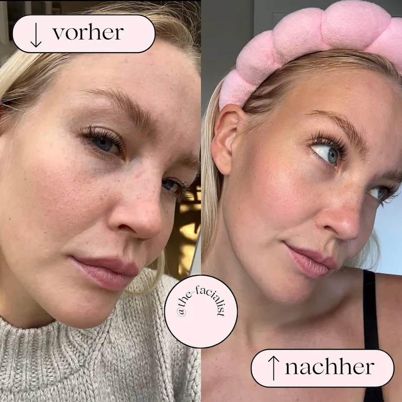 Vandbaseret Porerens med Hydrodermabrasion – Oxygen og Hydrogen Rens