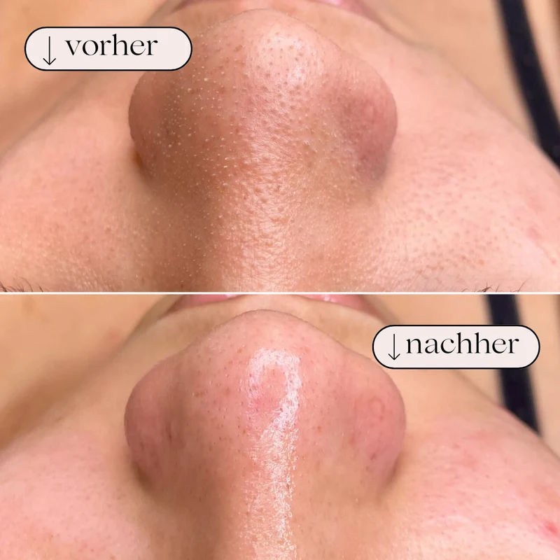 Vandbaseret Porerens med Hydrodermabrasion – Oxygen og Hydrogen Rens