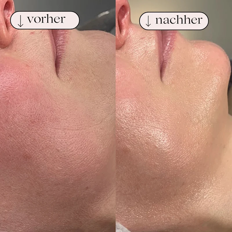 Vandbaseret Porerens med Hydrodermabrasion – Oxygen og Hydrogen Rens