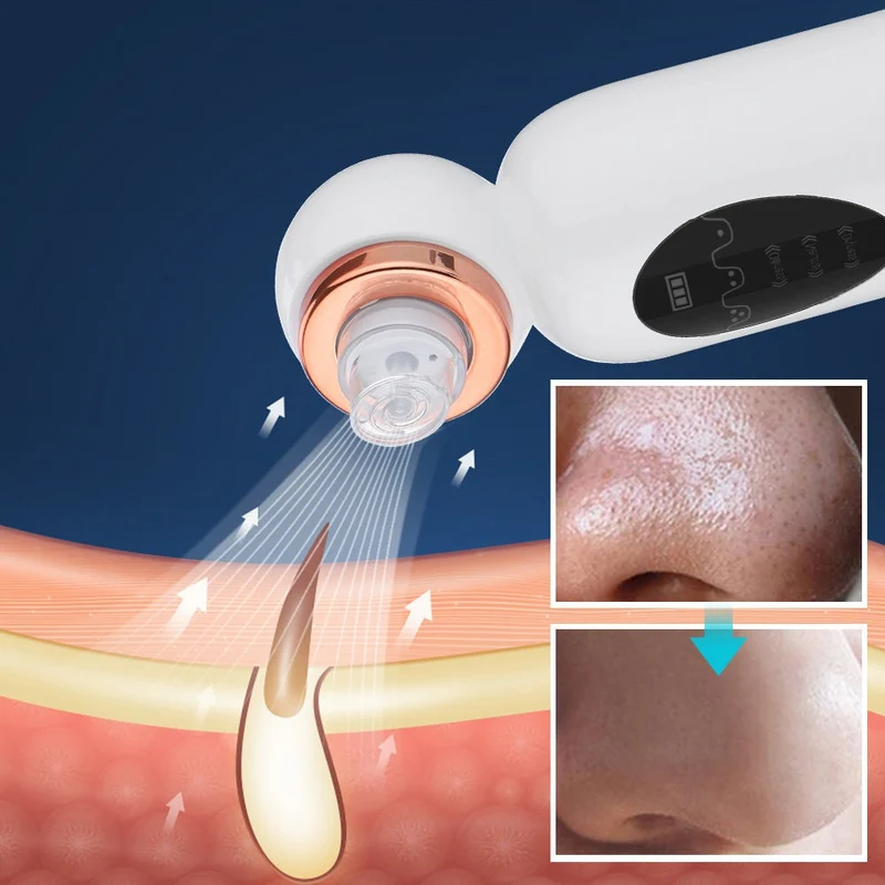 Hydrodermabrasion Enhed til Fjernelse af Mitesser