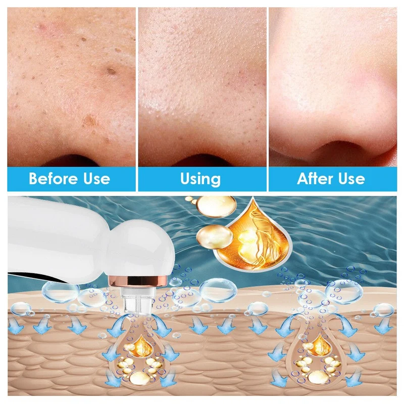 Hydrodermabrasion Enhed til Fjernelse af Mitesser