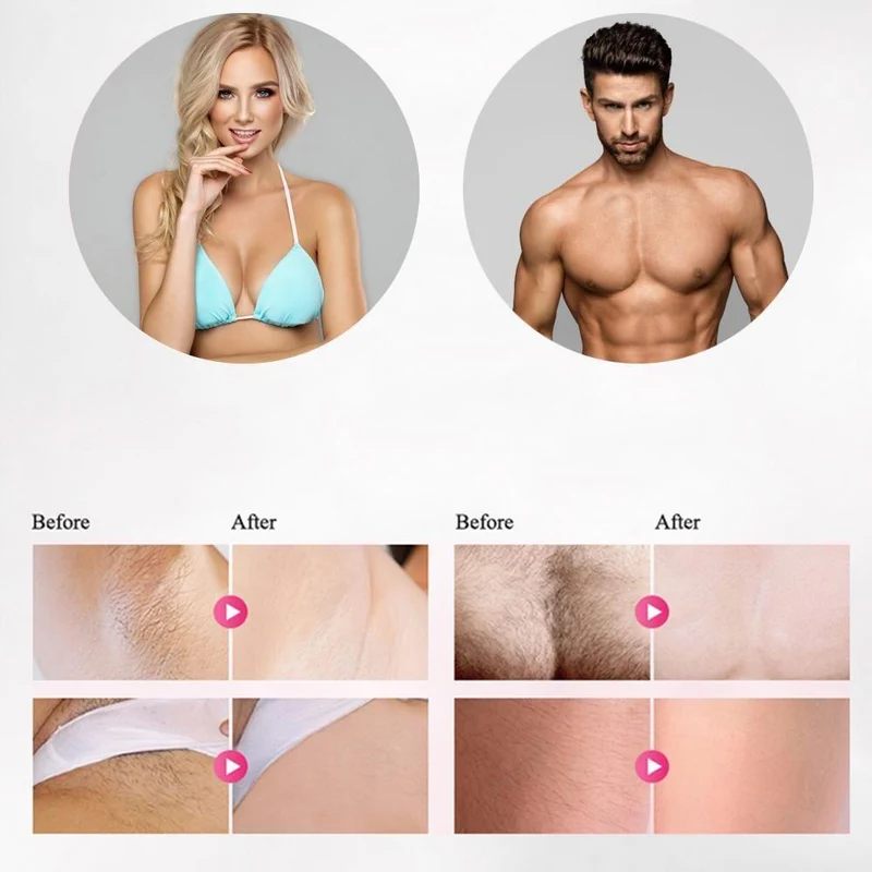 Professionel IPL Hårfjerner med Laser – Epilering Gerät