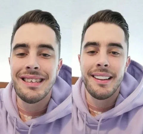 Strålende Smile Veneers til en perfekt tandlinje