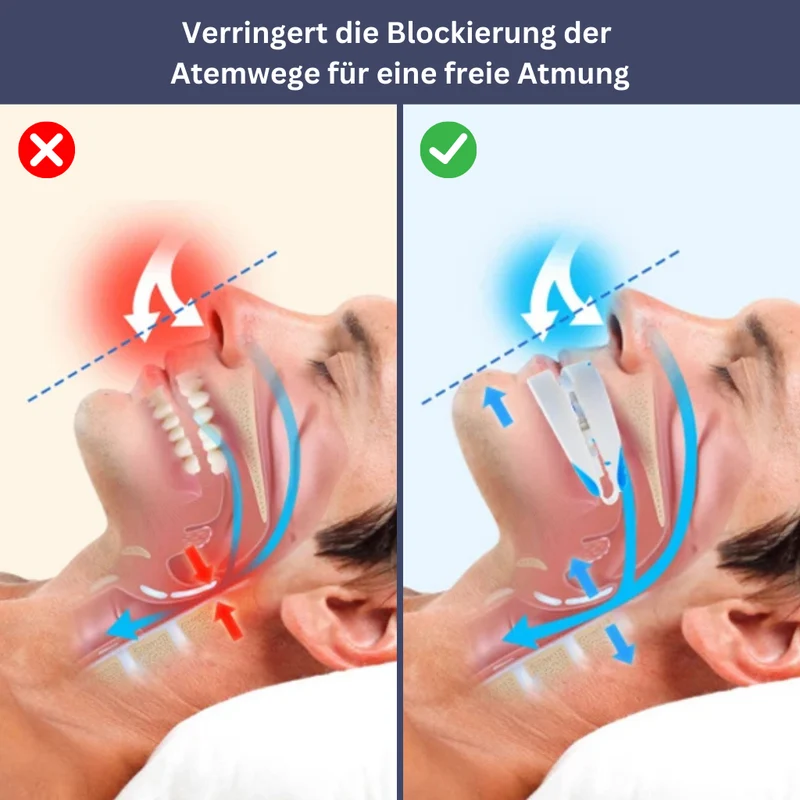 Effektiv Anti-Snorke Skinne for Roligere Nætter & Bedre Søvn