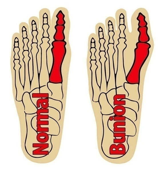 Effektiv Hallux Valgus Korriger – Komfort og Kvalitet i Fokus