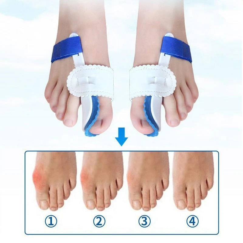 Effektiv Hallux Valgus Korrigeringsskinne til Natbrug
