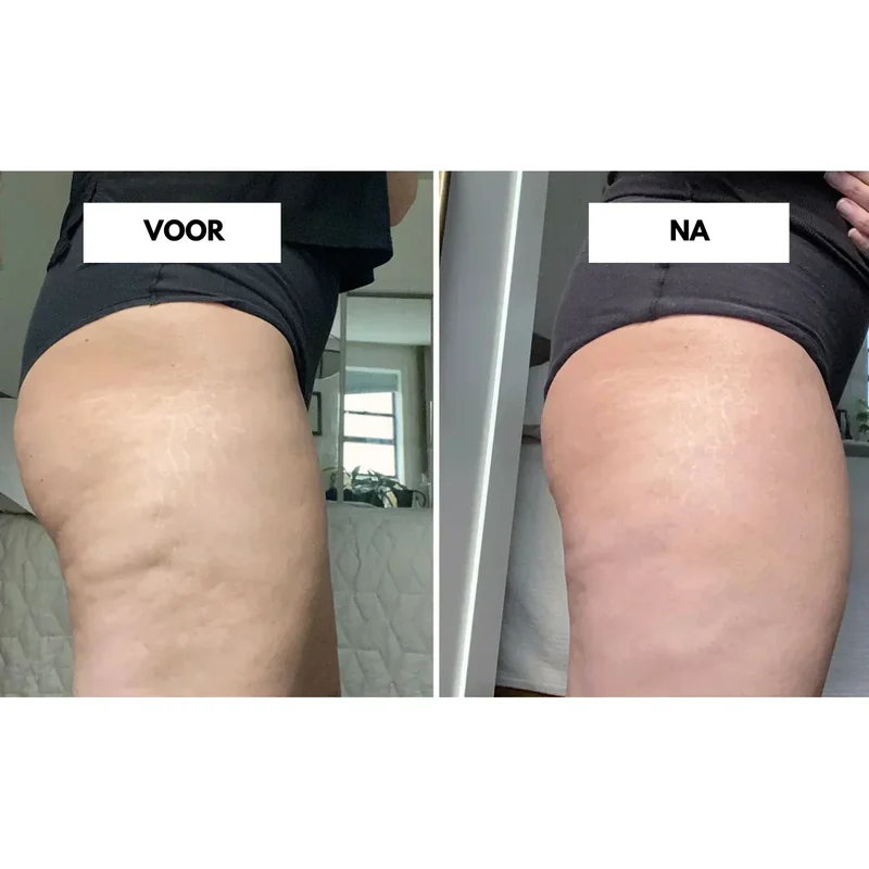 Effektiv vakuummassager til reduktion af cellulite